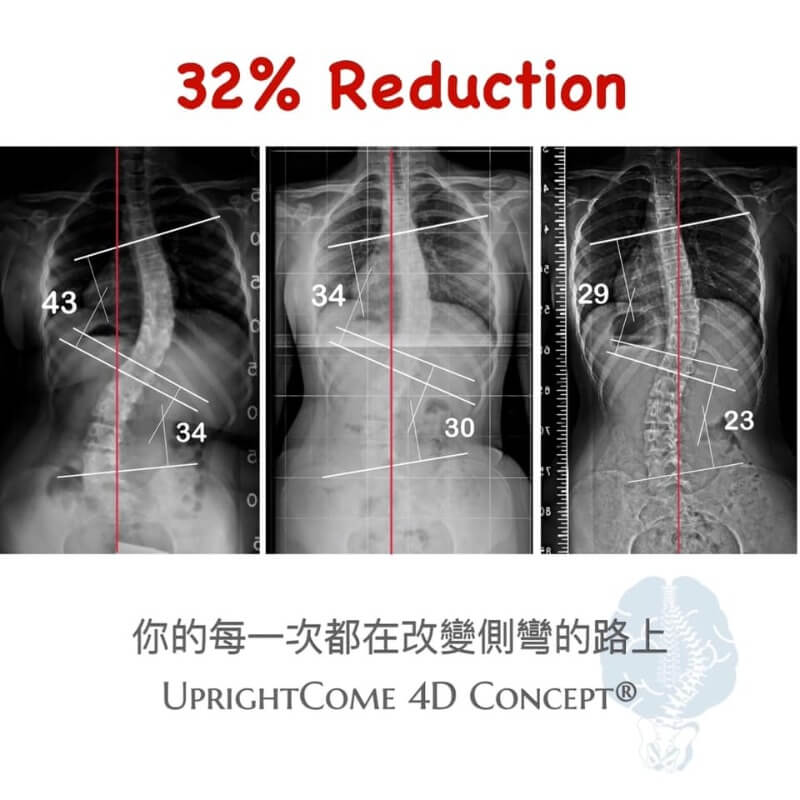 脊椎側彎就只能開刀嗎 挺立康脊椎側彎國際醫療中心