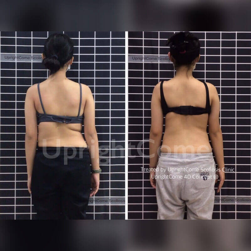 sports bra for scoliosis? : r/scoliosis