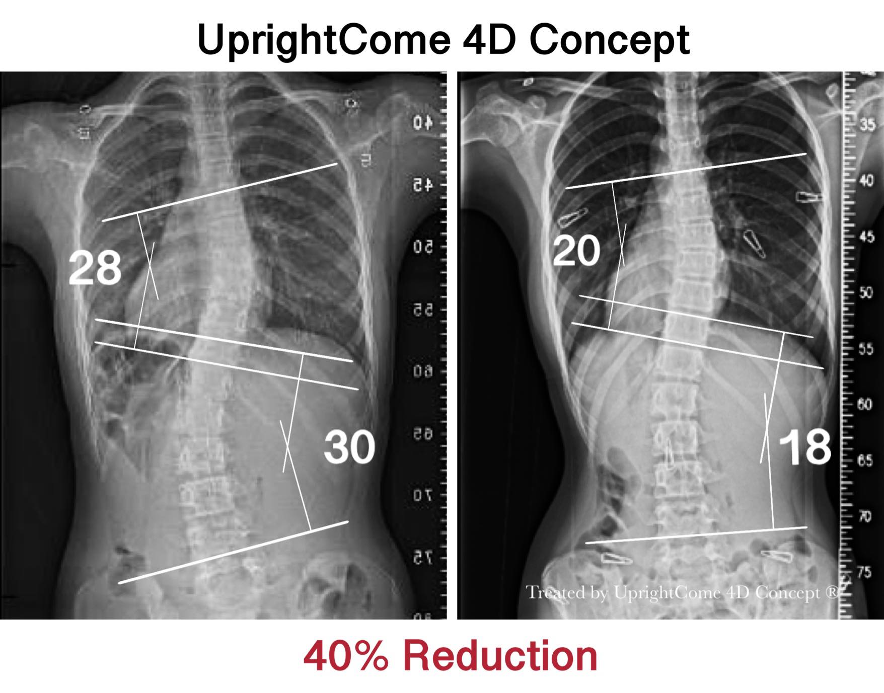 X Ray Uprightcome Scoliosis Clinic Scoliosis Correction Specialist